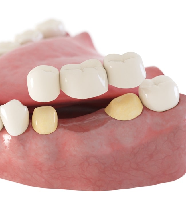 dental-bridges-in-simon-fraser-dental-centre