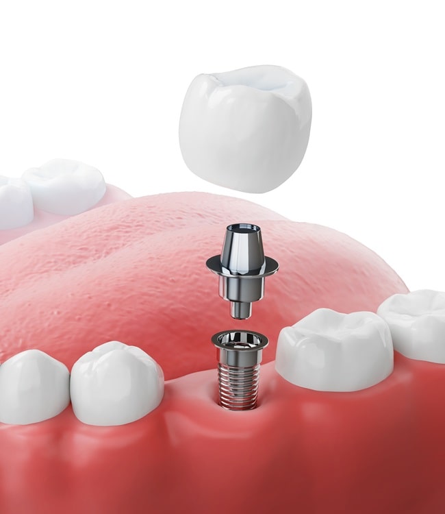 dental-implants-in-simon-fraser-dental-centre