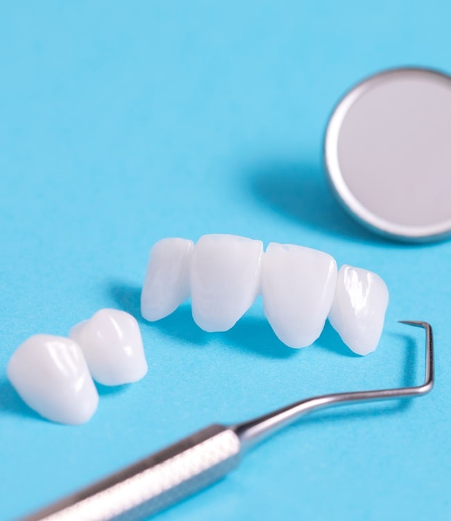 lumineers-in-simon-fraser-dental-centre