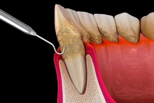 periodontics-simon-fraser-dental-centre