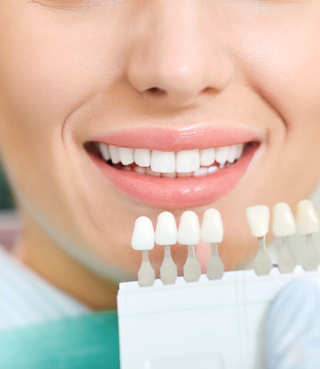 teeth-whitening-in-simon-fraser-dental-centre