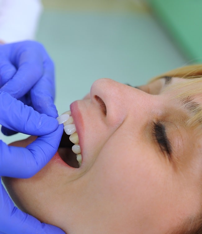 veneers-in-simon-fraser-dental-centre