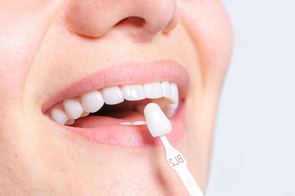 veneers-simon-fraser-dental-centre